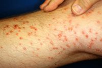 The Truth About Fire Ant Bites | Fire Ants